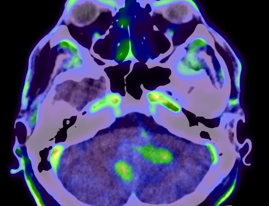Radiofármacos innovadores permiten diagnósticos más precisos en neuro-oncología y Parkinson.